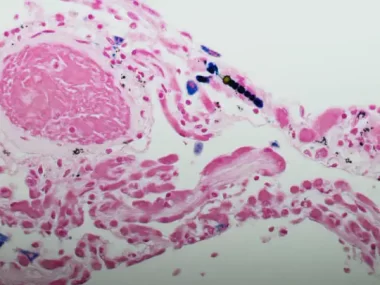 Mesothelioma