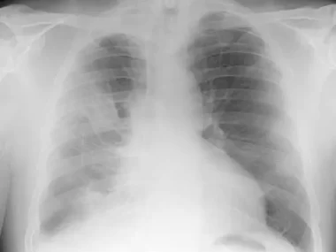 Mesothelioma Asbestos Lung Cancer