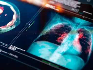 lung cancer from mesothelioma